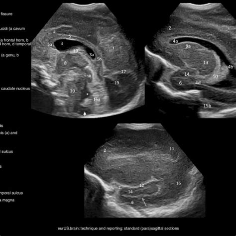 Pdf State Of The Art Neonatal Cerebral Ultrasound Technique And