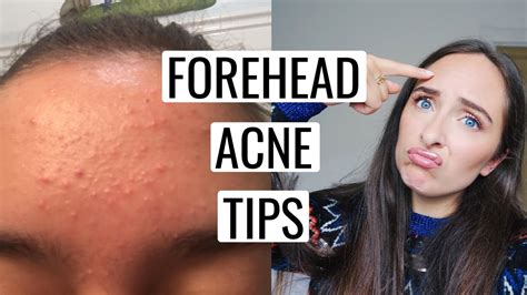 How To Get Rid Of Forehead Acne 🙌🏻 Youtube