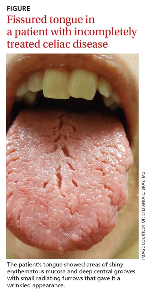 Red Patches On The Tongue With White Borders History Of Geographic