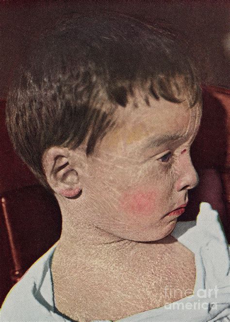 Boy With Ichthyosis Photograph By Larry Dunstan Science Photo Library
