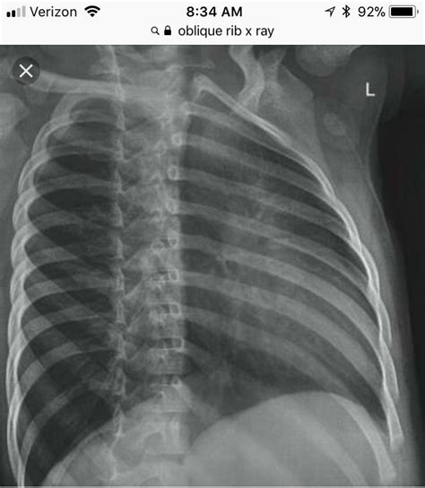 Top suggestions for anatomy under rib cage. Oblique Ribs- used to visualize anteriolateral/ posteriolateral | Radiology schools, Radiology ...