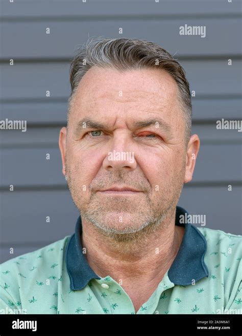 Swollen Eyelid Hi Res Stock Photography And Images Alamy