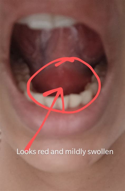 Red Bump Under Tongue