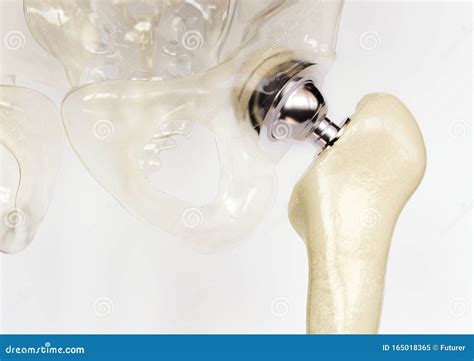 Artificial Hip Joint After Severe Osteoarthritis 3d Rendering Stock