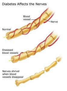 Diabetes is the most common. Nerve Damage Can Sometimes Be Reversed | Health Clover