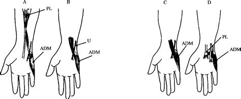 Pdf Median And Ulnar Nerve Compression At The Wrist Caused By