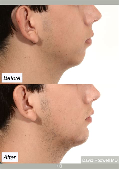 Chin Implants Enhance Your Facial Proportion Charleston Sc