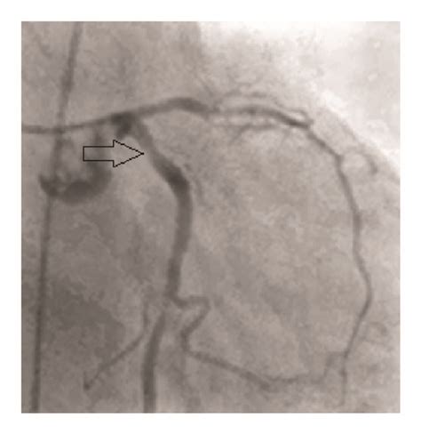 Tight Severe Stenosis 95 Of The Proximal Lad In A Patient With