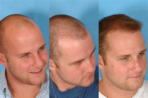 All Sizes Hair Transplant Before After AG12 07 Hairline Results