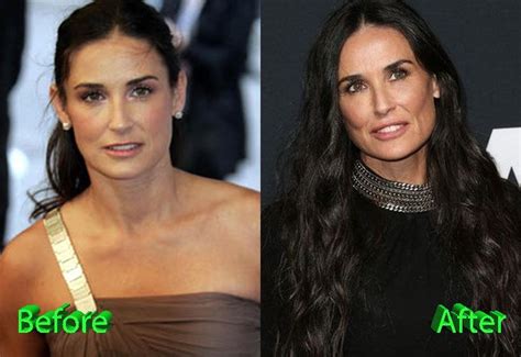 Demi Moore Surgery Transformation Before And After Plastic Surgery