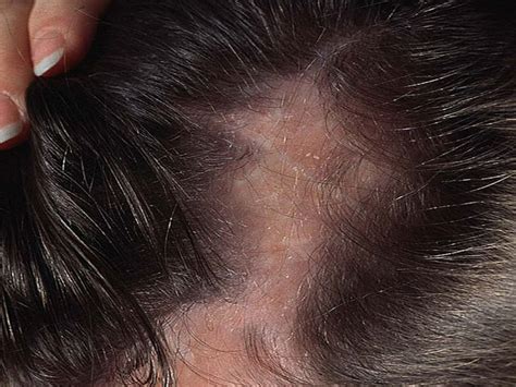 What Is Scarring Alopecia Causes Symptoms And Treatments