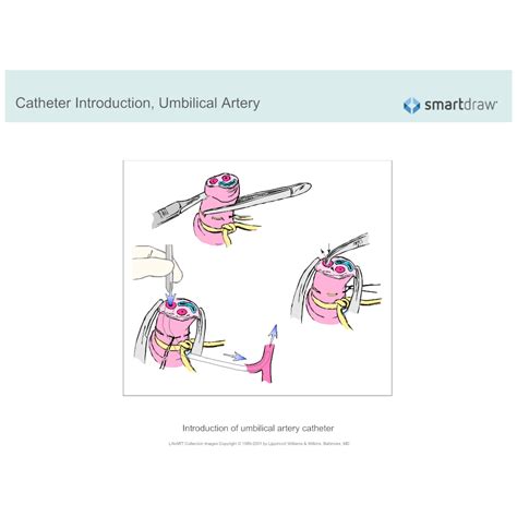 Catheter Introduction Umbilical Artery