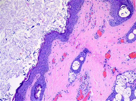 Pathology Outlines Eyelid Cysts