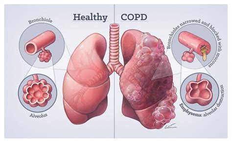 Copd Rudrax Chest Clinic