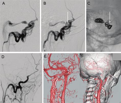 A Right Occipital Artery Angiogram Demonstrated An Avf At The