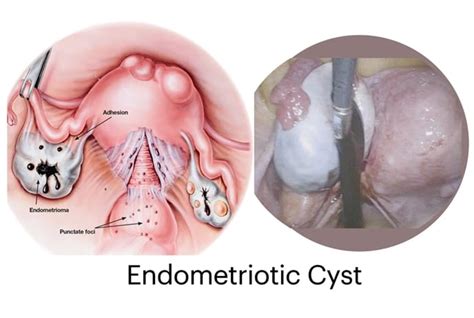 Blood Cyst Endometriosis Dr Anthony Siow