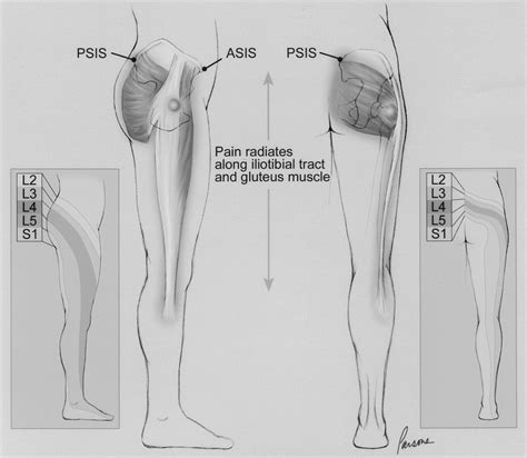 Greater Trochanteric Pain Syndrome In Patients Referred To Orthopedic