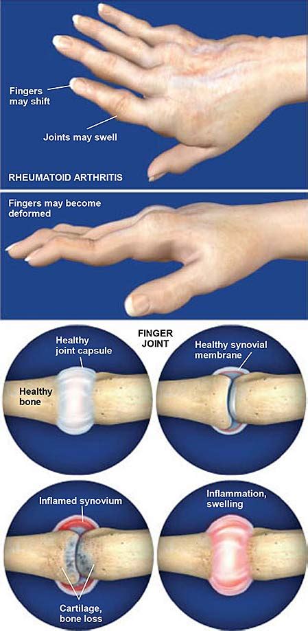 Rheumatoid Arthritis Ra Of The Hand Central Coast Orthopedic Medical Group