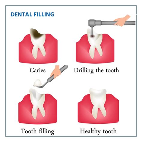 Dental Cavity Filling
