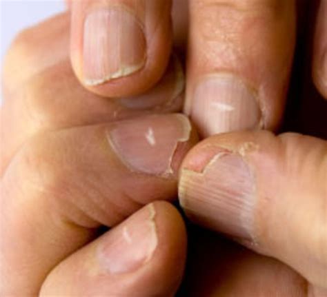 White Spots And Vertical Ridges On The Fingernails Symptoms Stock Photo