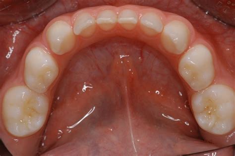 Mandibular Deciduous Teeth Without Caries General View Doccheck