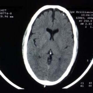 These are located at the base of your fore brain. A-Small Deep Intracerebral bleed in the bilateral basal ...