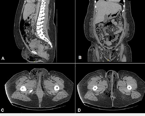 Ct Of Abdomen And Pelvis With Contrast Demonstrating Subcutaneous