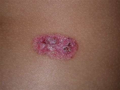 Cura tumore cutaneo Torino - dott. Delmonte dermatologo Torino