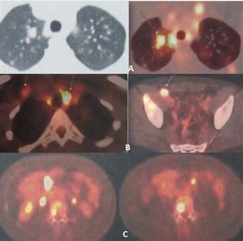 Fdg Pet Scan Showed Hypermetabolic Apical Right Nodule Of The Lung