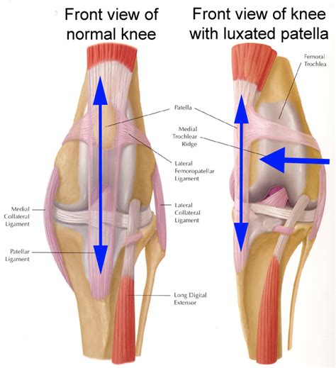 Kneecap Dislocation Patellar Subluxation Treatment Symptom And Causes