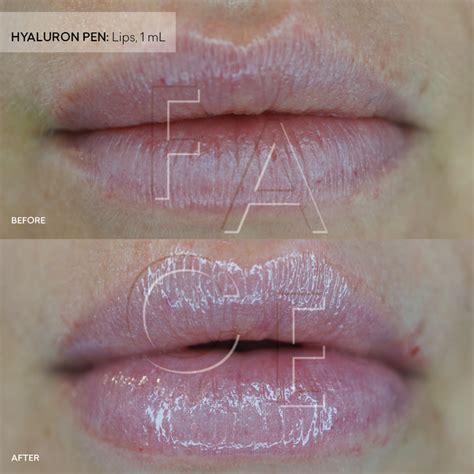 Needleless Lip Filler What It Is And How It Compares To Injectables — Face