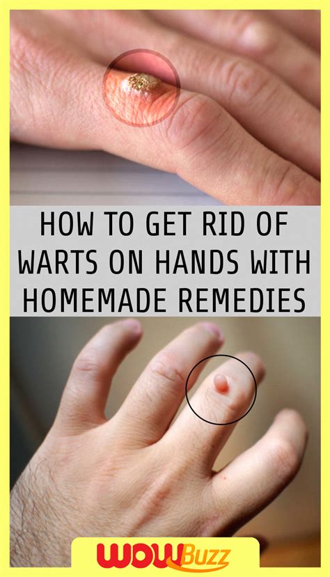 Easy Methods To Do Away With Warts Naturally Wartsonfeet