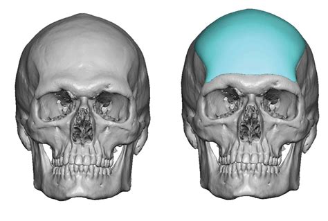 Plastic Surgery Case Study Custom Forehead Augmentation In Male