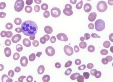 What Is Anisocytosis Definition Causes And Treatment