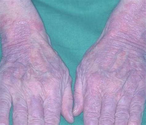 Lupus Rash Pictures Life Expectancy Contagious Symptoms Treatment
