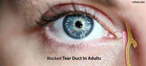 Blocked Tear Duct In Adults Risks And Prevention Tips