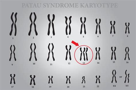 Síndrome De Patau Trissomia 13 O Que é Sintomas E Cariótipo Dasa