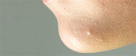 Molluscum Molluscum Treatment In Cardiff Specialist Skin Clinic