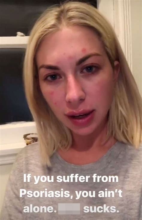 Stassi Schroeder Suffers From Psoriasis Shares Makeup Free Photo