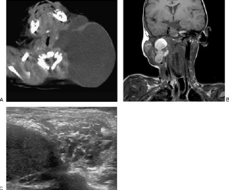 A Contrast Enhanced Axial Computed Tomography Through The Neck Shows