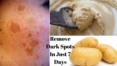 Remove Dark Spots In Just Days With Potato My Xxx Hot Girl