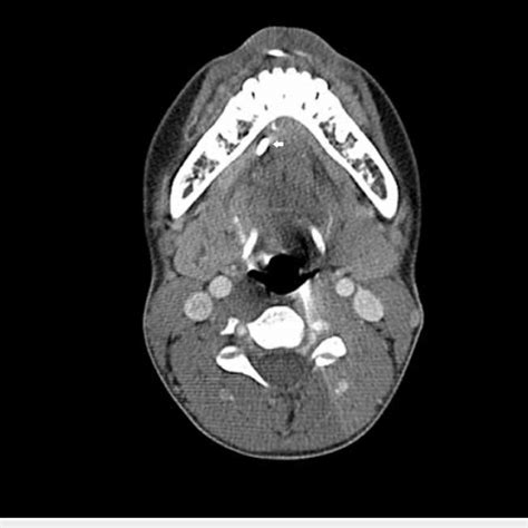 Ct Scan Of The Neck Axial View With A Stone White Arrow Seen In The