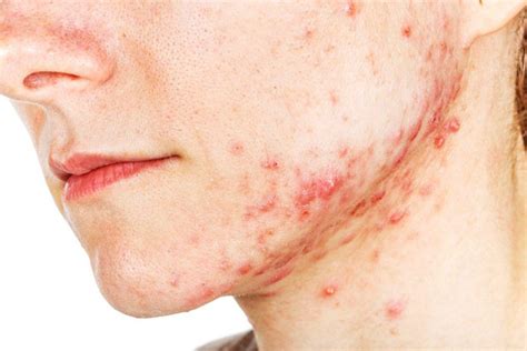 What Your Acne Says About Your Health Readers Digest