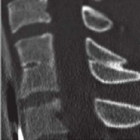 Sagittal Ct Images Of The Cervical Spine Demonstrating Incidentally