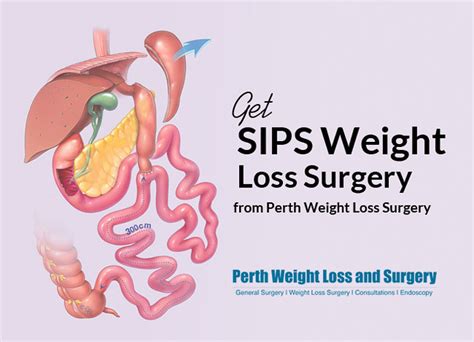 Get Sips Weight Loss Surgery From Perth Weight Loss Surger Flickr