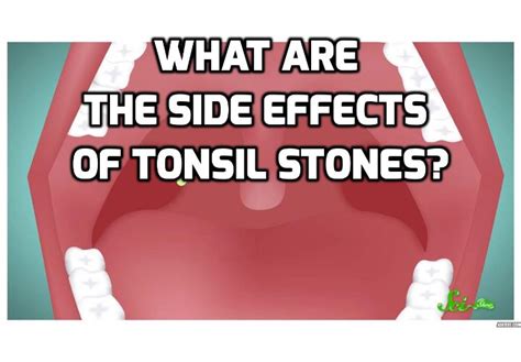 What Are The Side Effects Of Tonsil Stones Anti Aging Beauty