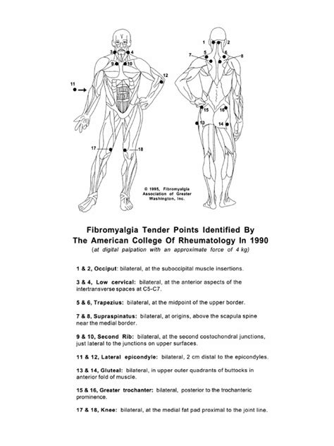 Fibromyalgia tender points are areas of pain around joints, but not in the joints themselves. 50096668 Fibromyalgia Tender Points