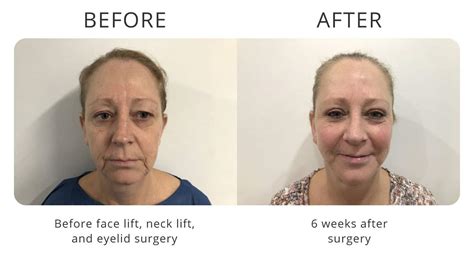 Facelift Surgery And Neck Lift Surgery My Cosmetic Clinic