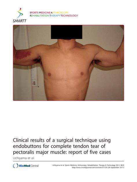 Pdf Clinical Results Of A Surgical Technique Using Endobuttons For
