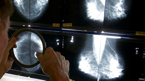 Shorter Drug Treatment Ok For Many Breast Cancer Patients